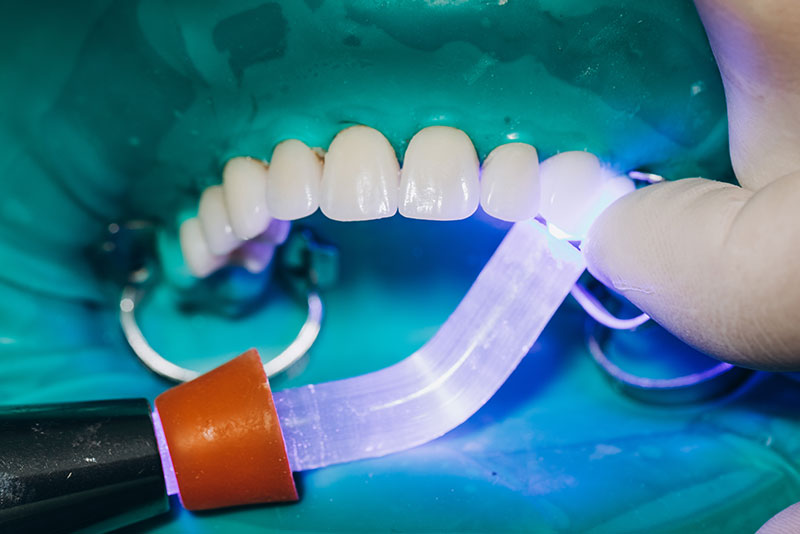Lumineers, Zahnbehandlung, Veneers Alternative