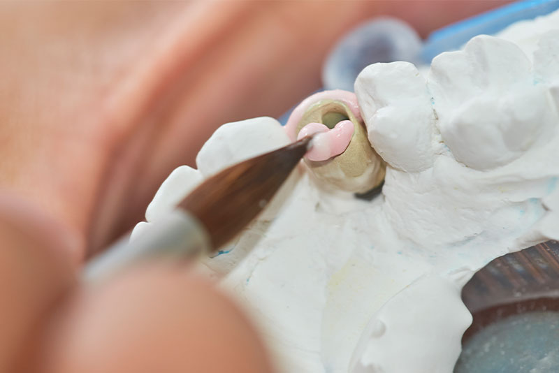 Zahn Inlay, Zahn Onlay, Zahnklinik Türkei, Dental Inlay Türkei