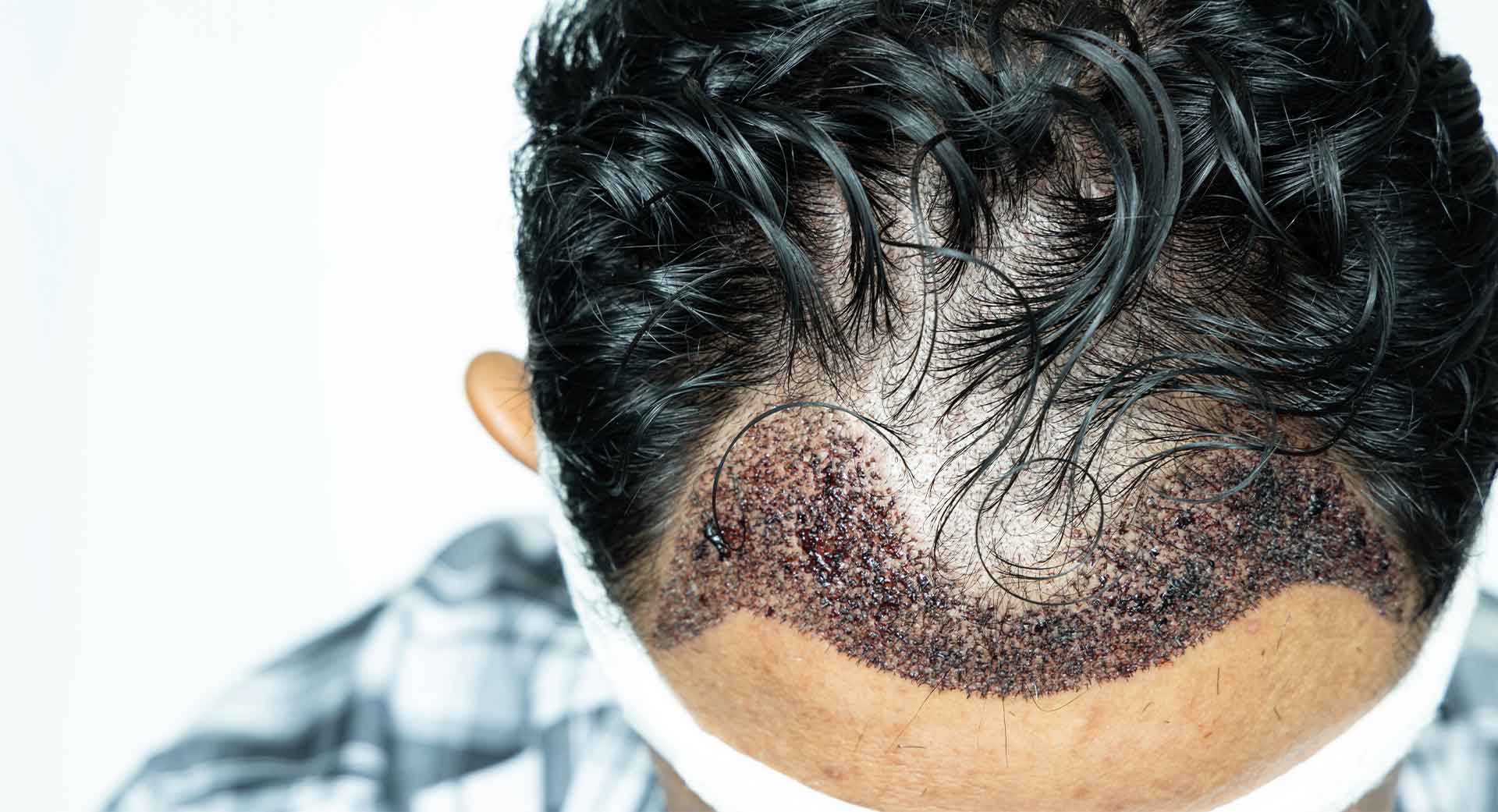Haartransplantation-billig